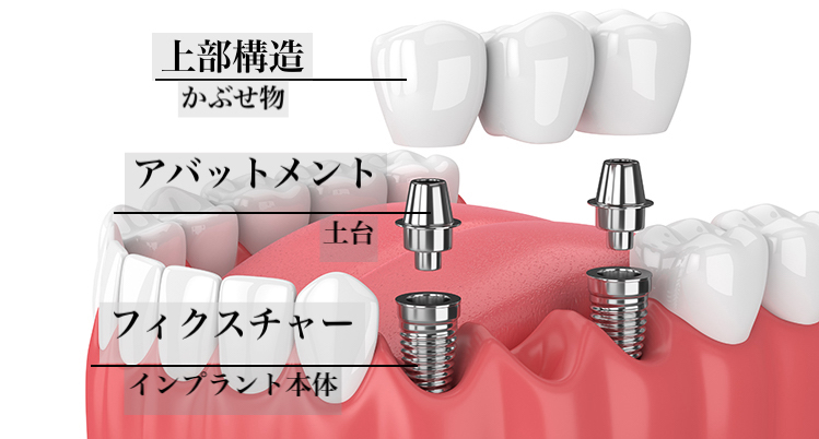 インプラントについて