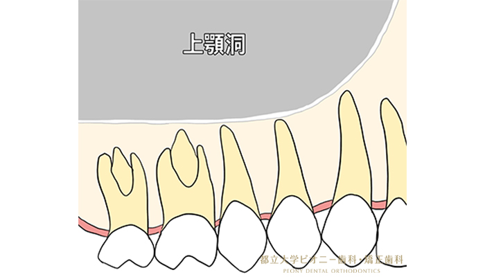 サイナスリフトの流れ