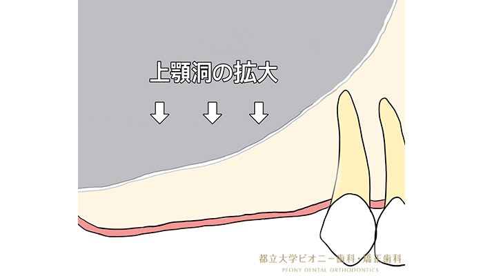 サイナスリフトの流れ