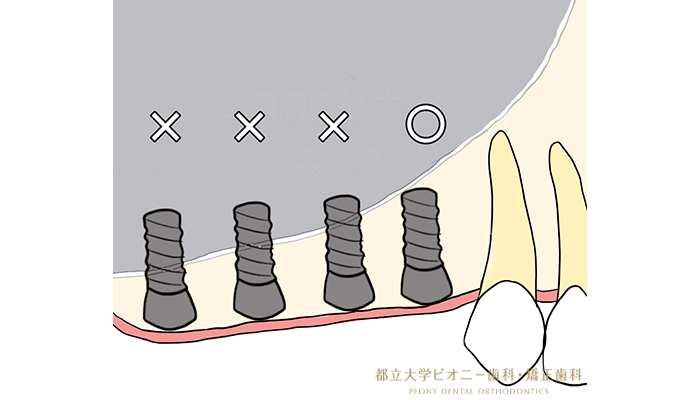 サイナスリフトの流れ