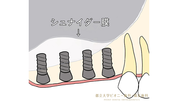 サイナスリフトの流れ