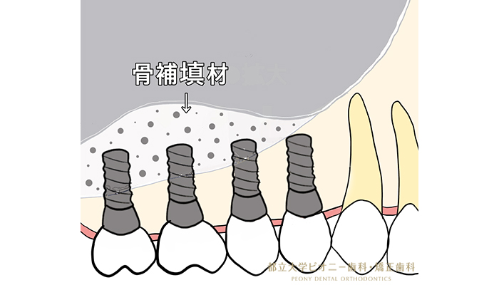 サイナスリフトの流れ