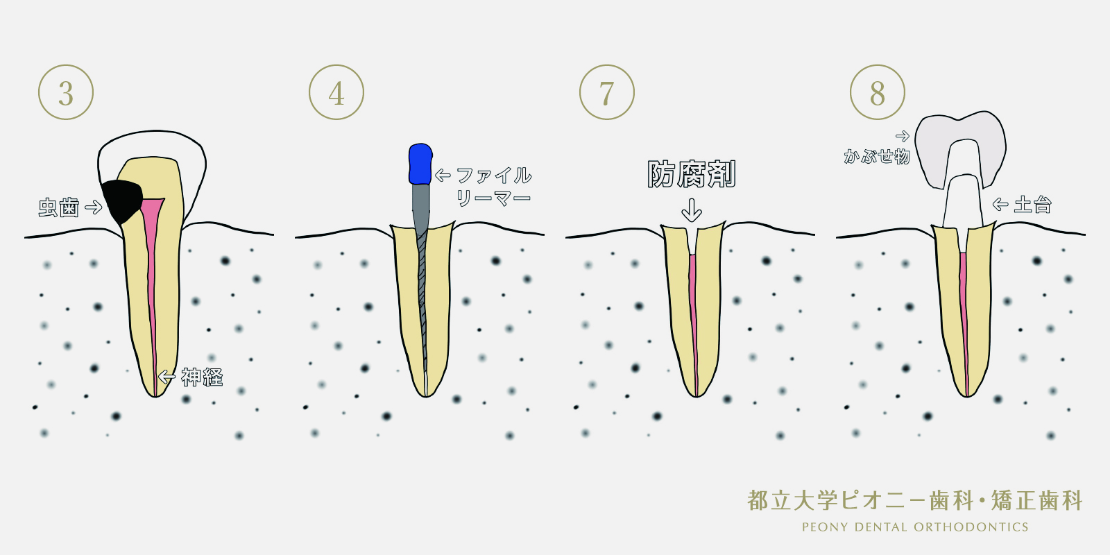 歯の神経が残っている場合の治療の流れ