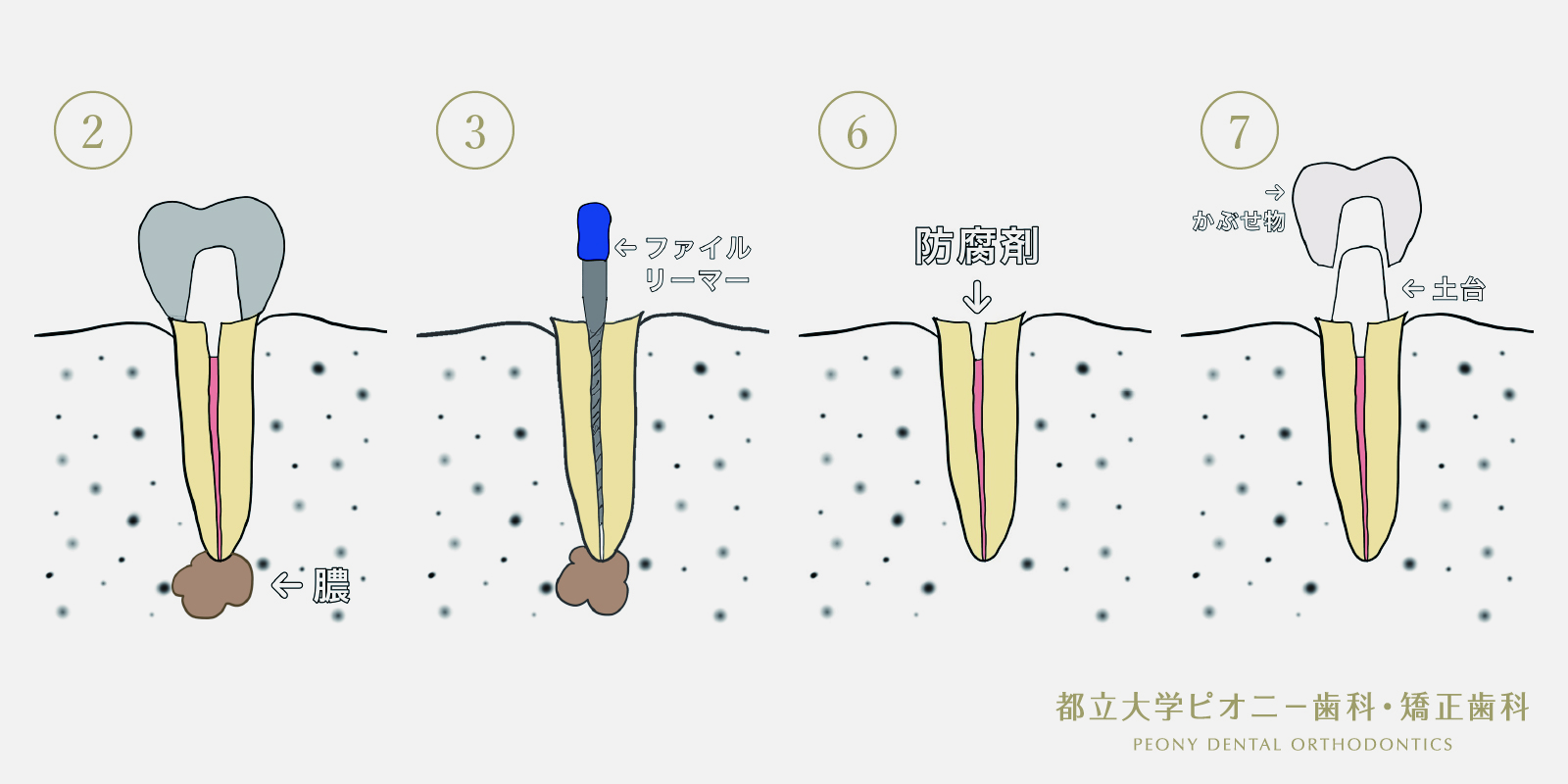 歯の神経が残っていない場合の治療の流れ